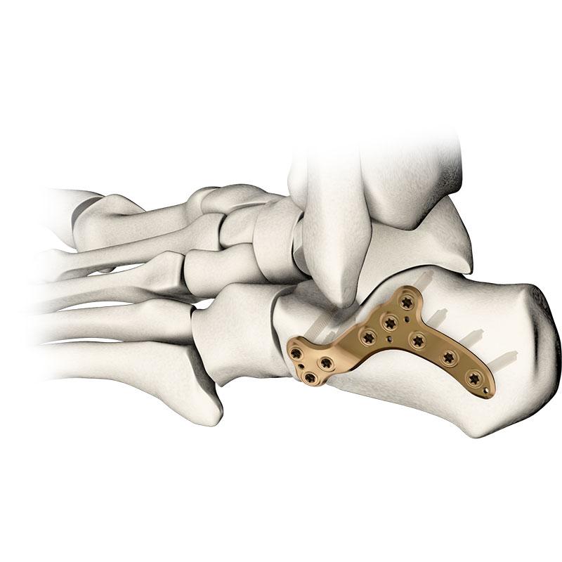 Пластина для п'яти 5.0ChLP